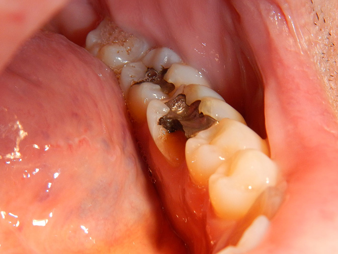 Fractured Tooth Around Filling